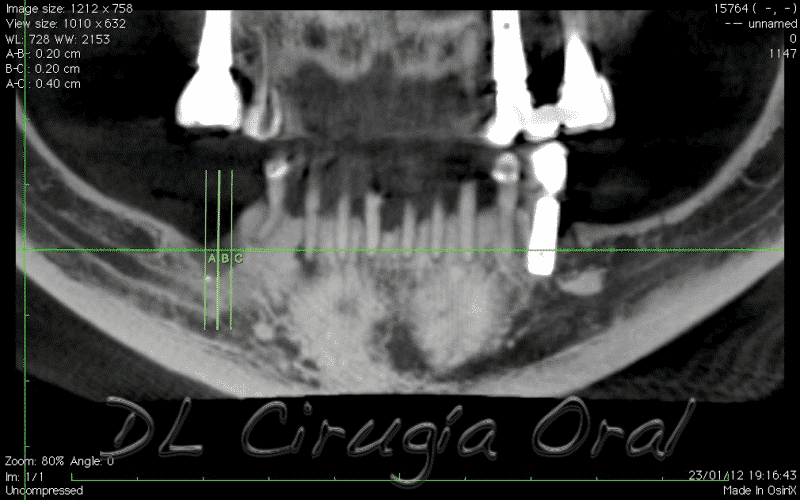 Reconstrucción mandibular posterior