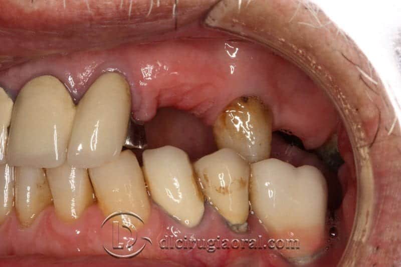 cirugía de implantes compleja