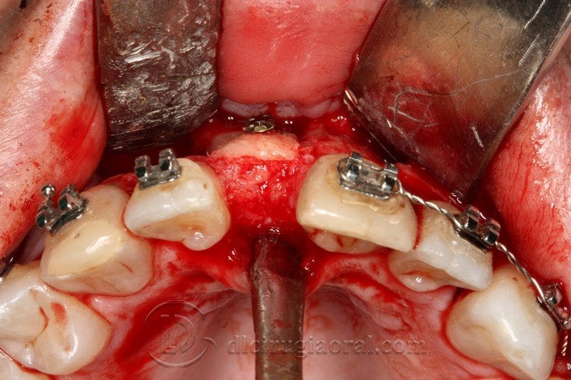 Regeneración ósea horizontal zona estética: Atrofia en incisivo central