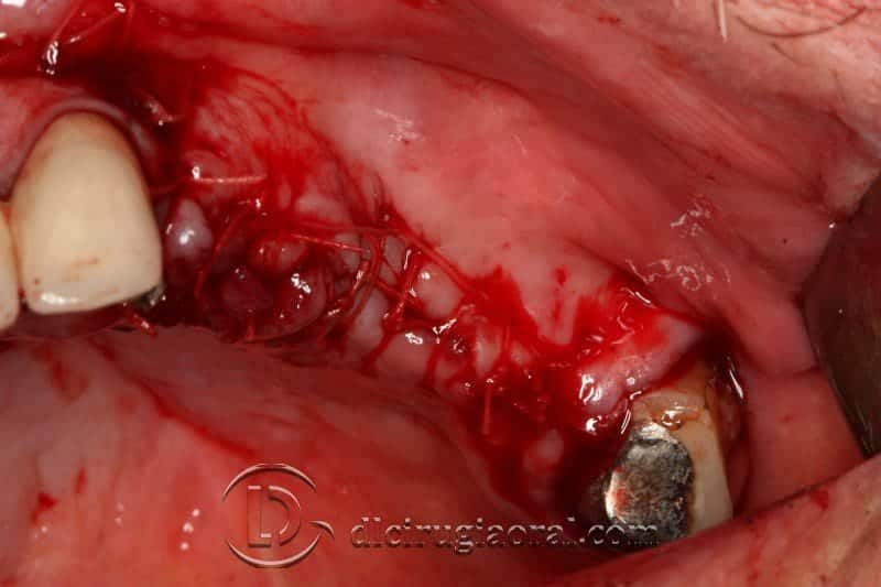 Cirugía oral con varias técnicas