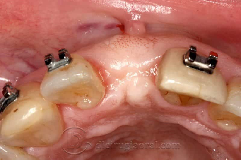 Regeneración ósea horizontal zona estética: Atrofia en incisivo central