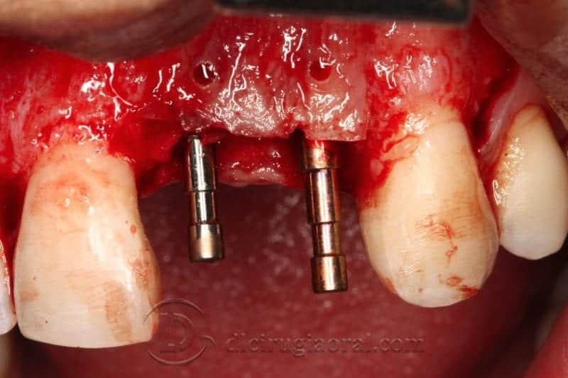Paralismo de los implantes