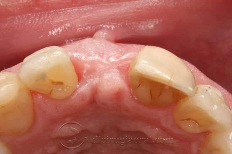 Regeneración ósea horizontal zona estética: Atrofia en incisivo central
