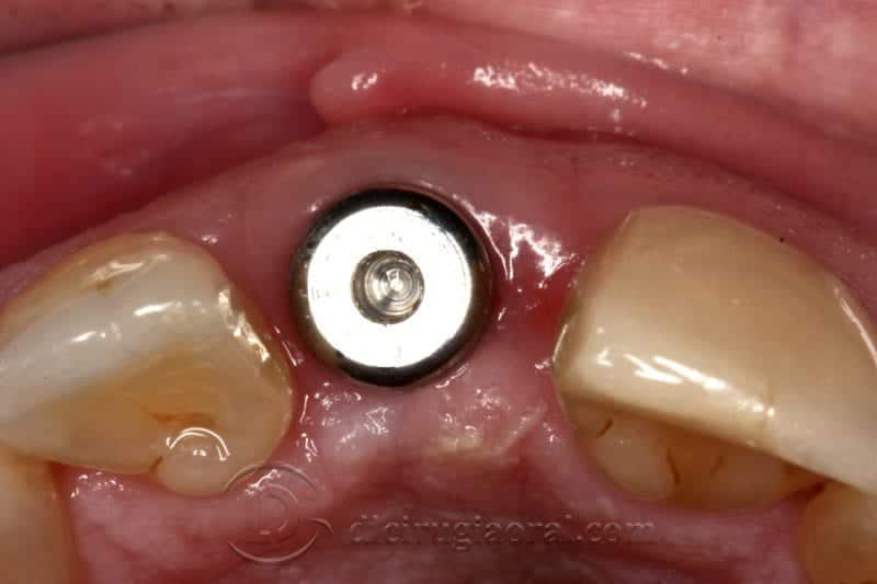 Regeneración ósea horizontal zona estética: Atrofia en incisivo central
