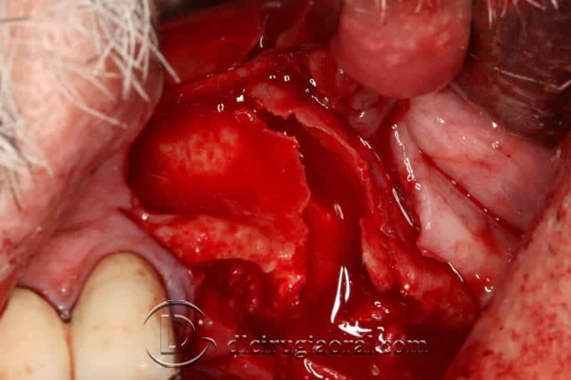 cirugía oral compleja