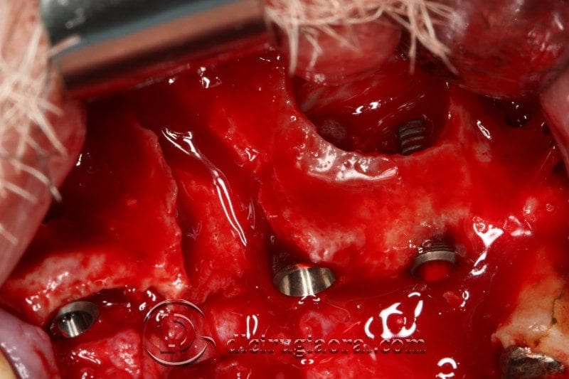 Cirugía oral con varias técnicas