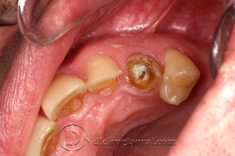 Exodoncia canino