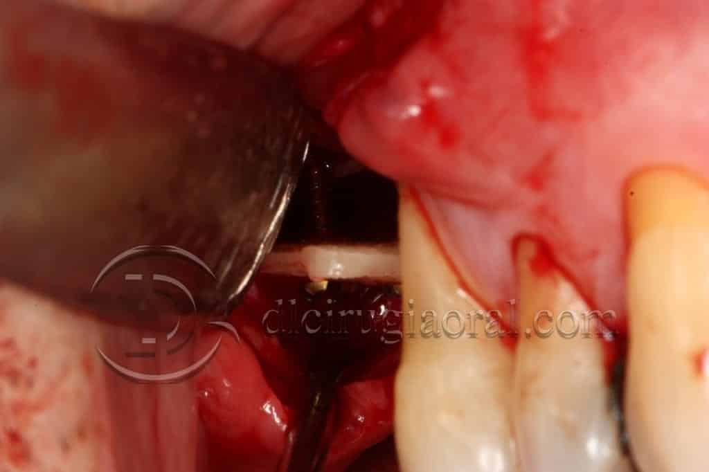 curso sobre reconstrucción maxilar