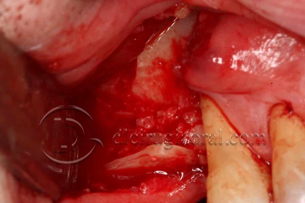 curso sobre reconstrucción maxilar