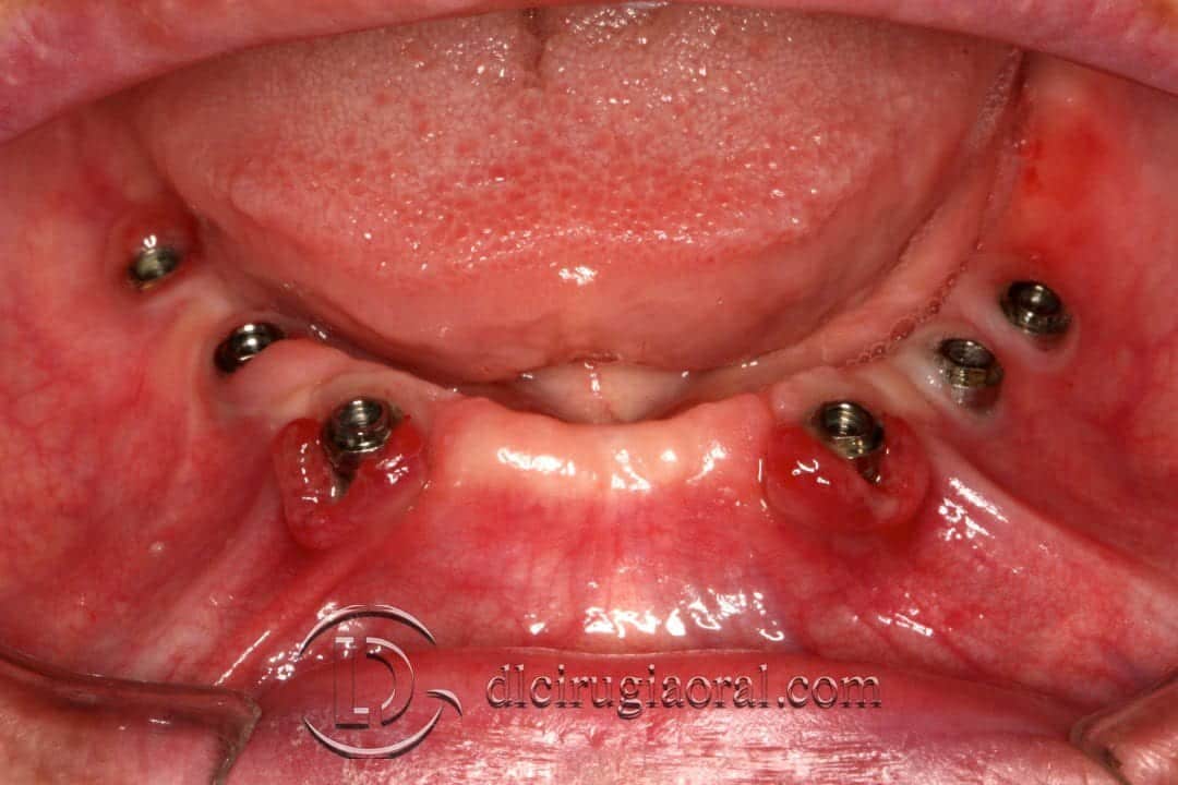 Injerto libre epitelial en periimplantitis
