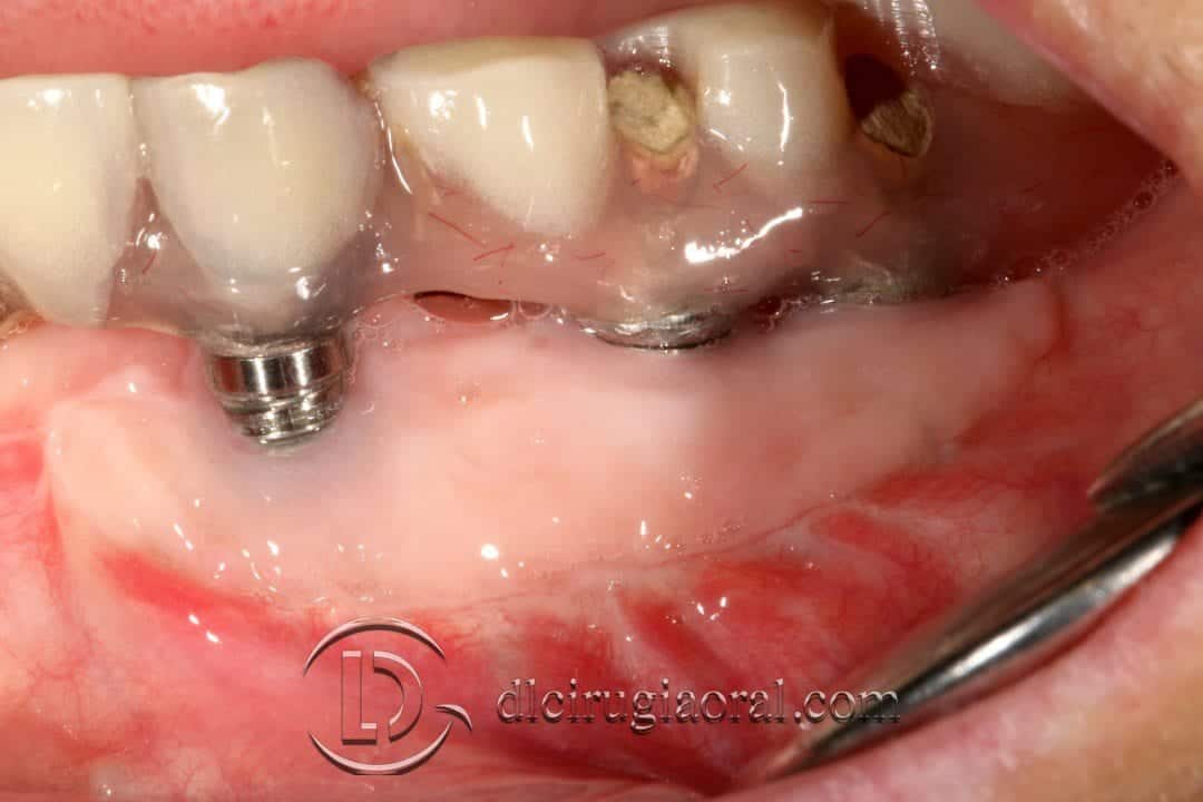 Injerto libre epitelial en periimplantitis tratamiento