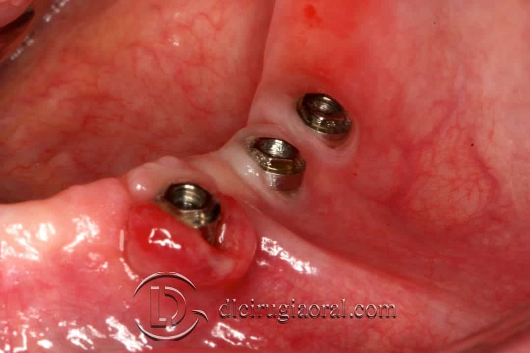 Injerto libre epitelial en periimplantitis mucositis