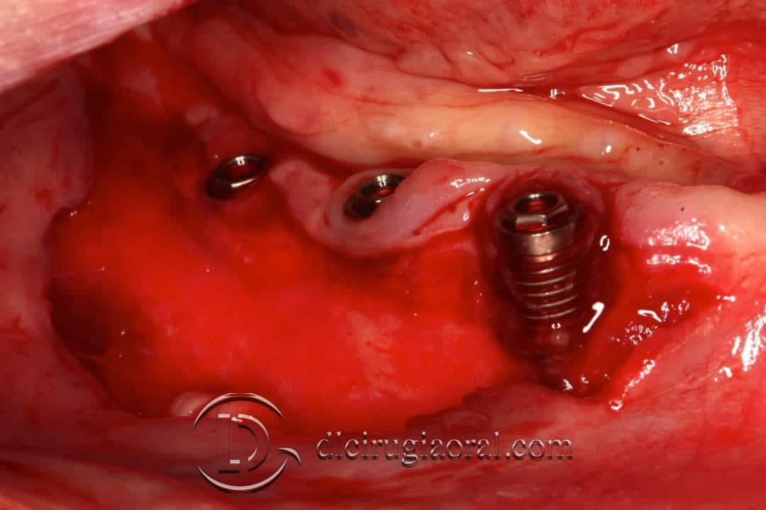 Injerto libre epitelial en periimplantitis pérdida de soporte óseo