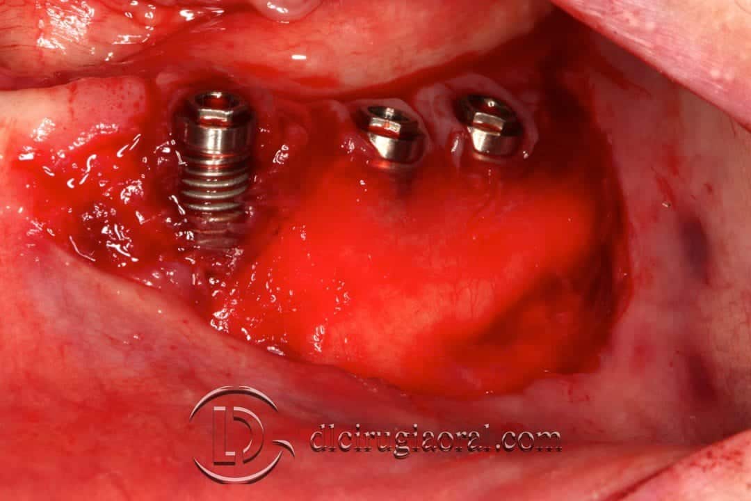 Injerto libre epitelial en periimplantitis