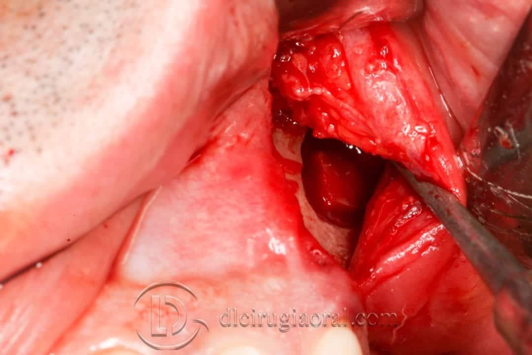 curso de cirugía oral