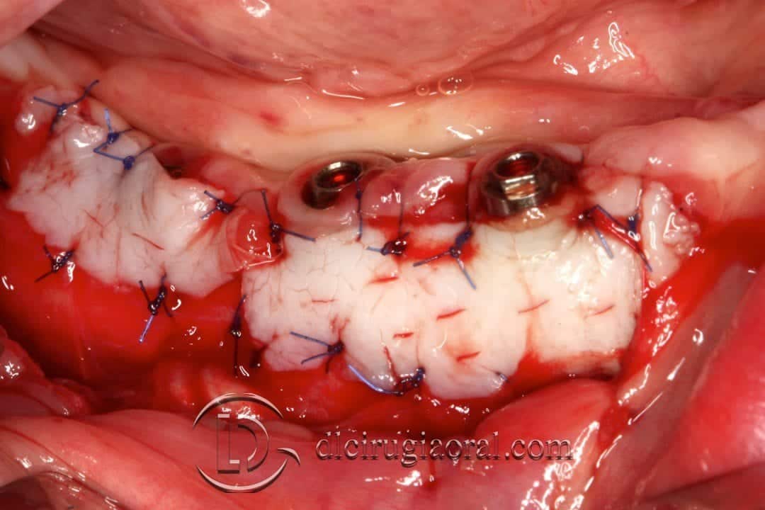 Injerto libre epitelial en periimplantitis