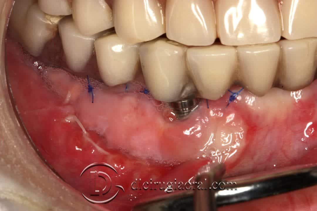 Injerto libre epitelial en periimplantitis evolución a la semana