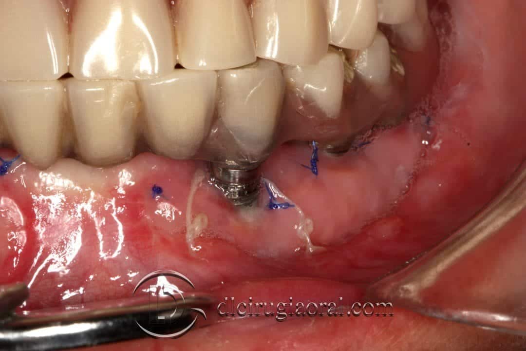 Injerto libre epitelial en periimplantitis