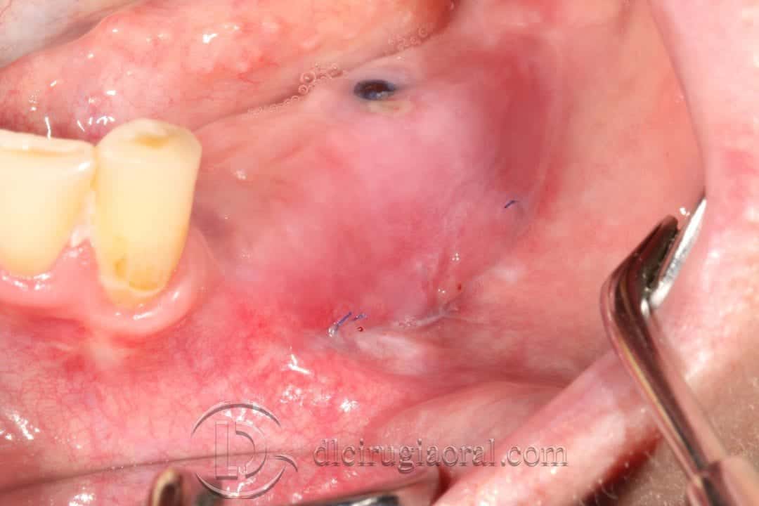 Vestibuloplastia de Kazanjian