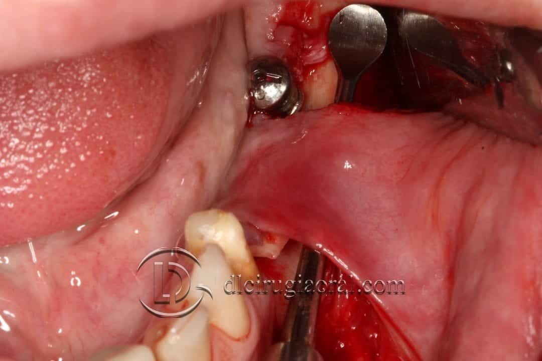 implantes sobre reconstrucción mandibular