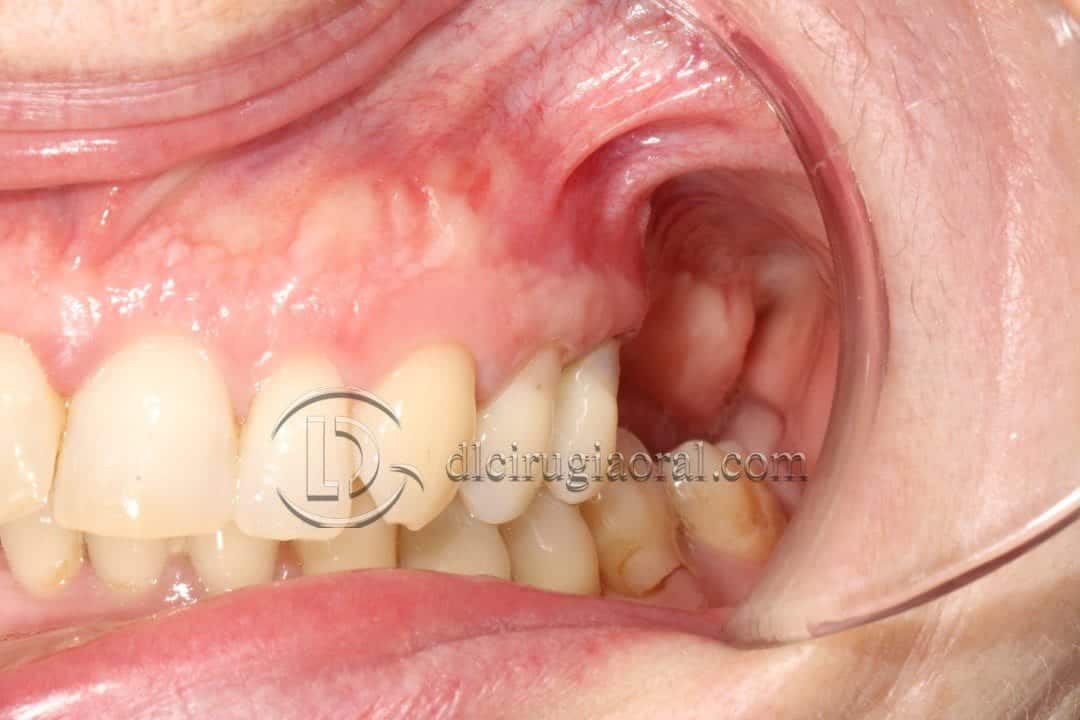 Perforación membrana Schneider
