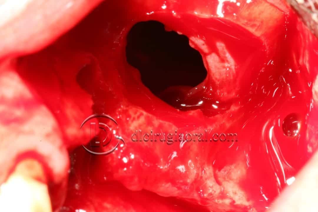 Complicaciones: Perforación membrana de Schneider + ausencia de tabla vestibular