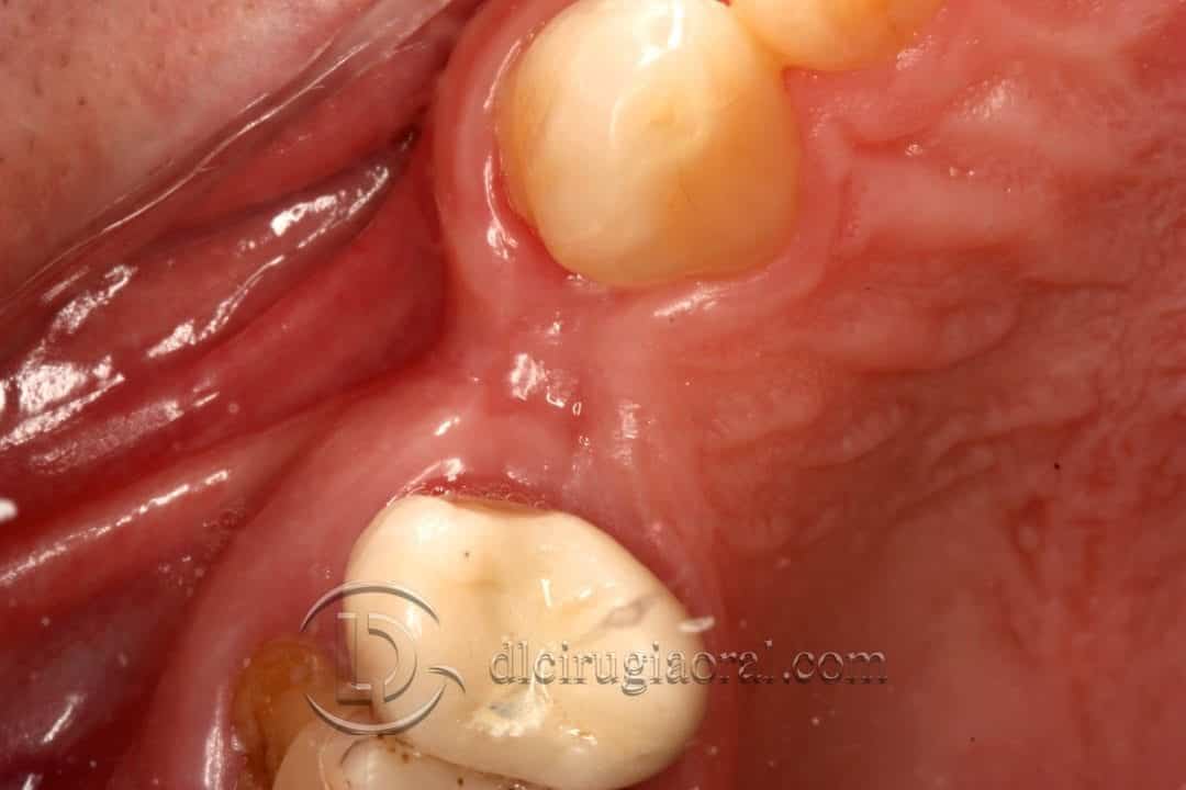 defecto horizontal en premolar superior