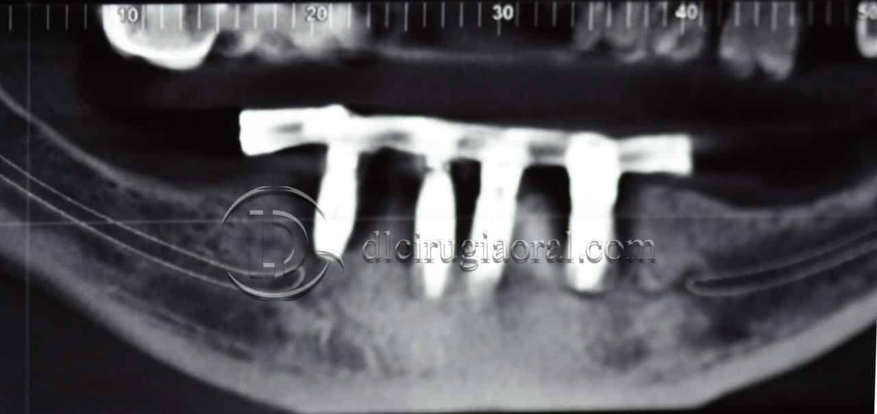implantes dentales en sobredentadura inferior