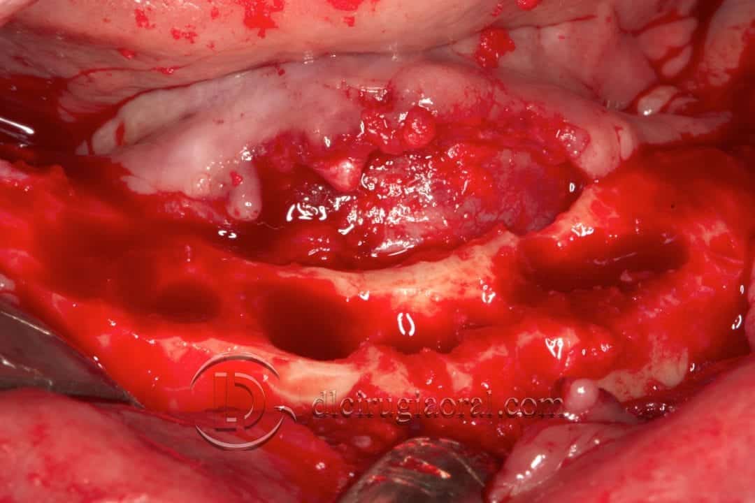 implantes dentales en sobredentadura inferior