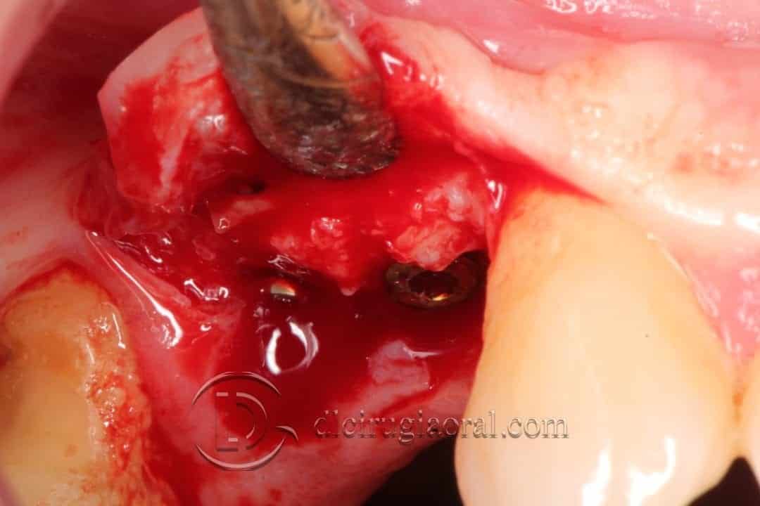 defecto horizontal en premolar superior