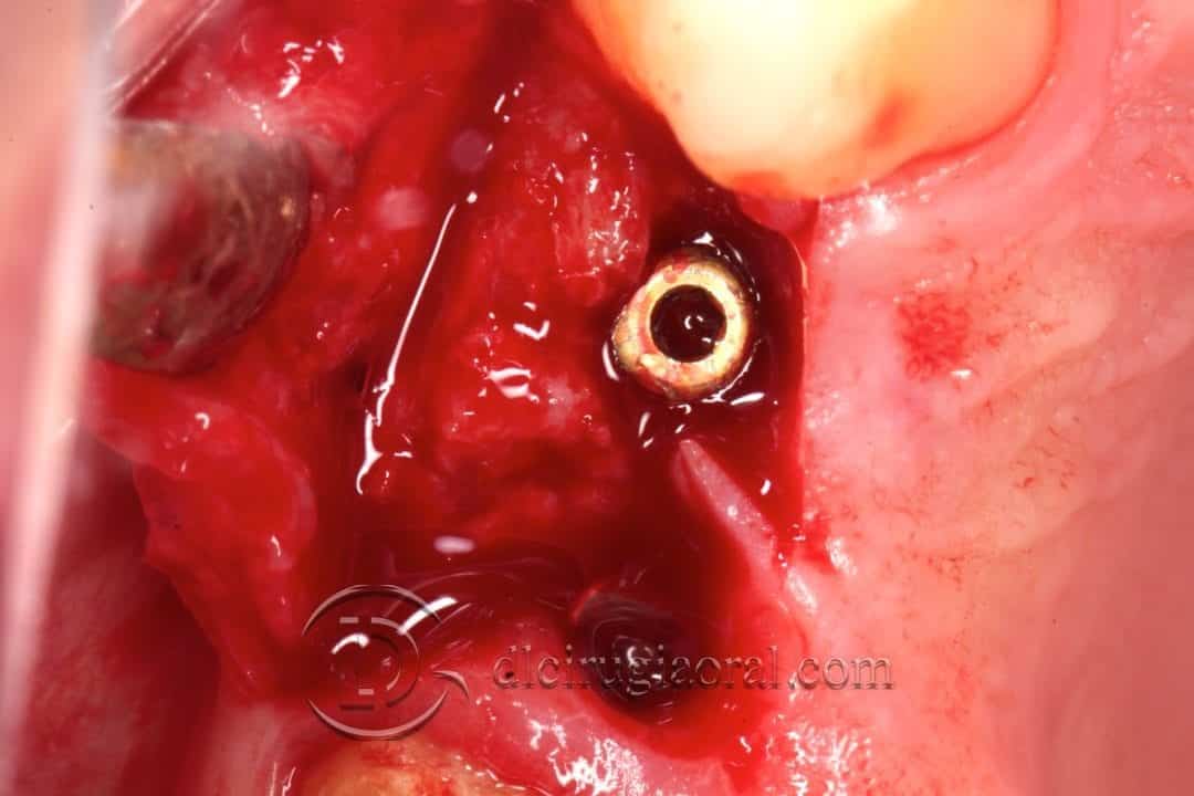 defecto horizontal en premolar superior
