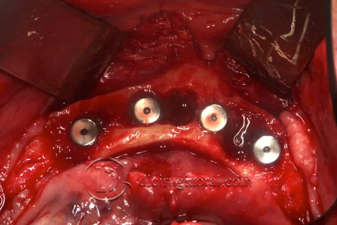implantes dentales en sobredentadura inferior