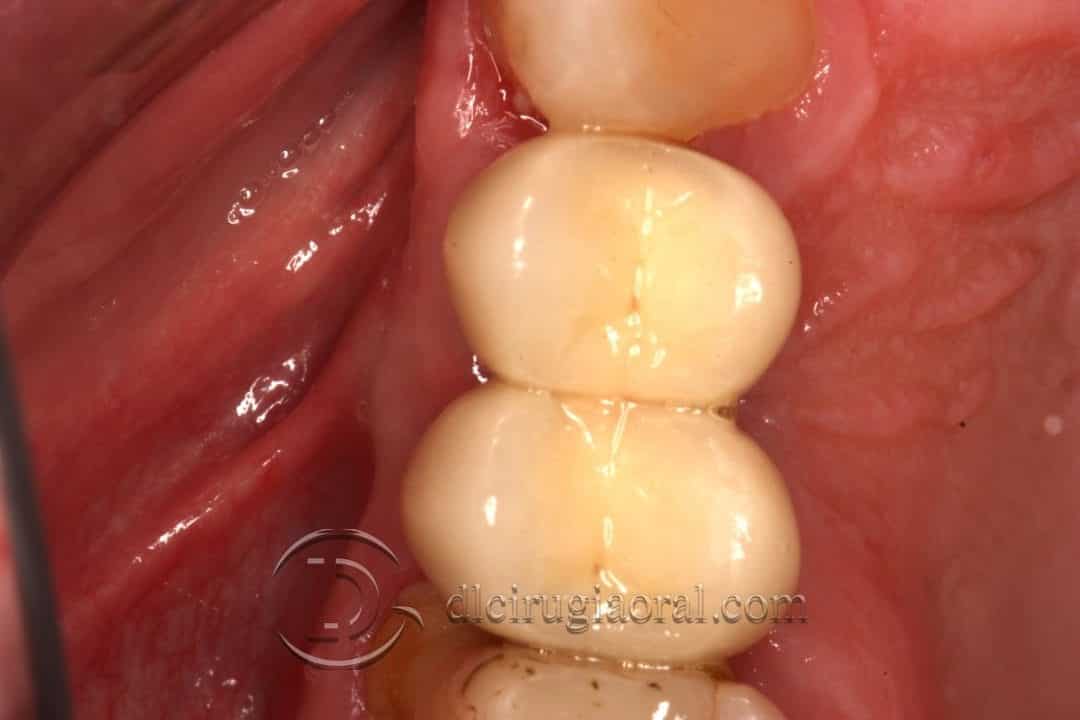 defecto horizontal en premolar superior