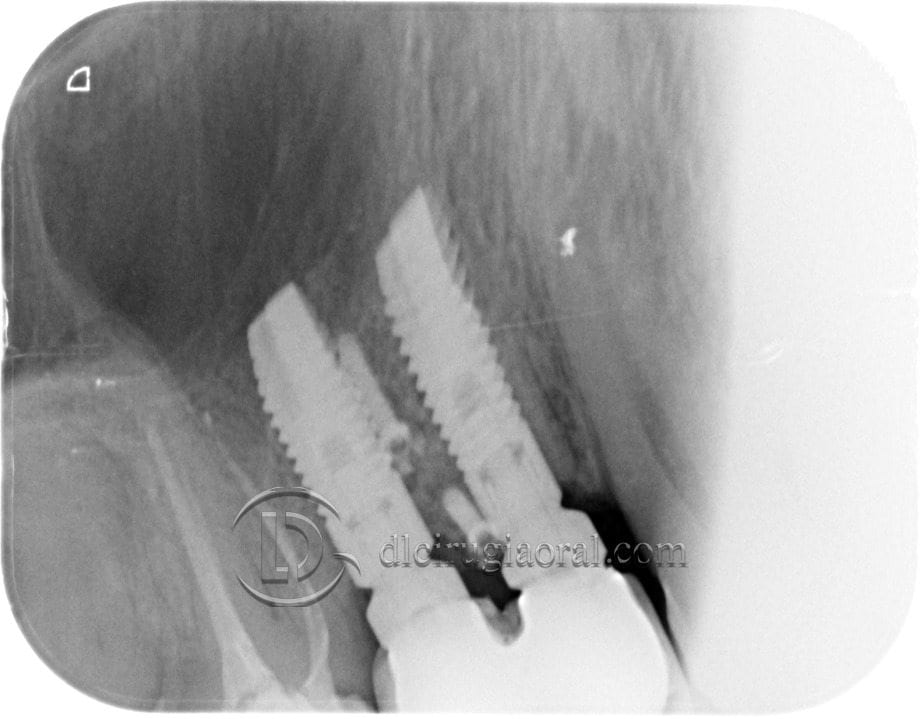 defecto horizontal en premolar superior