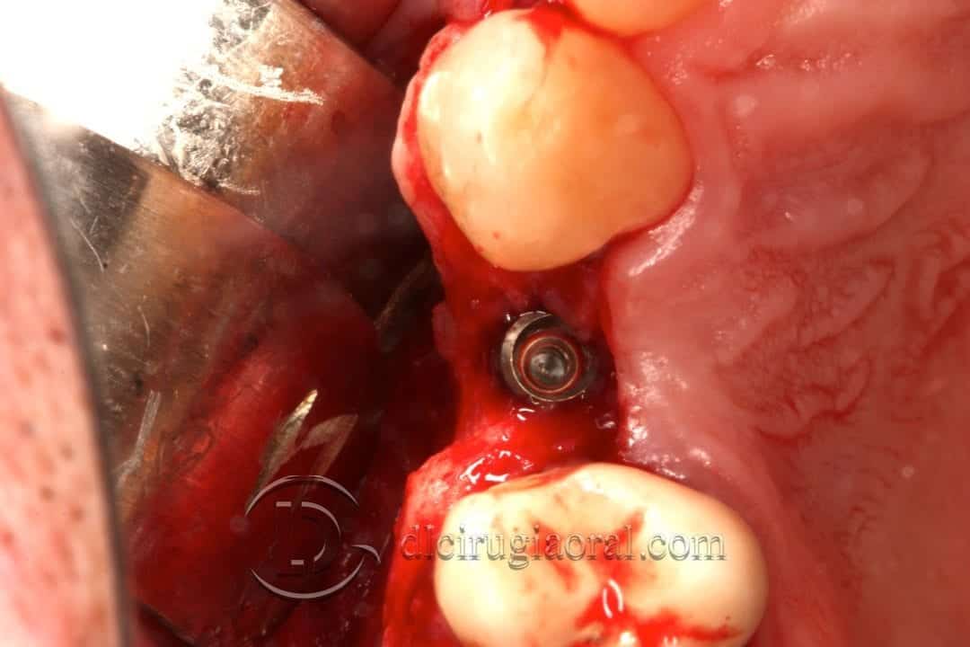 defecto horizontal en premolar superior
