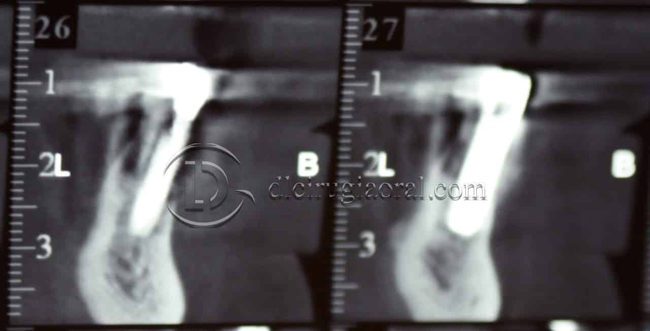 implantes dentales en sobredentadura inferior