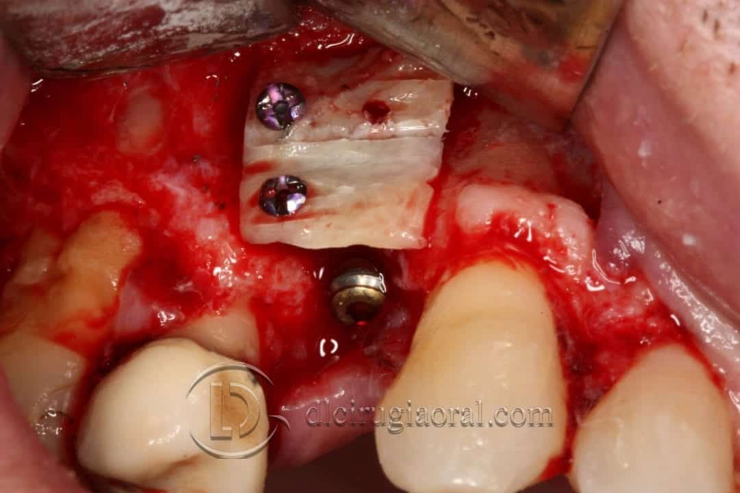 defecto horizontal en premolar superior