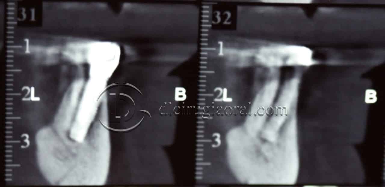 implantes dentales en sobredentadura inferior