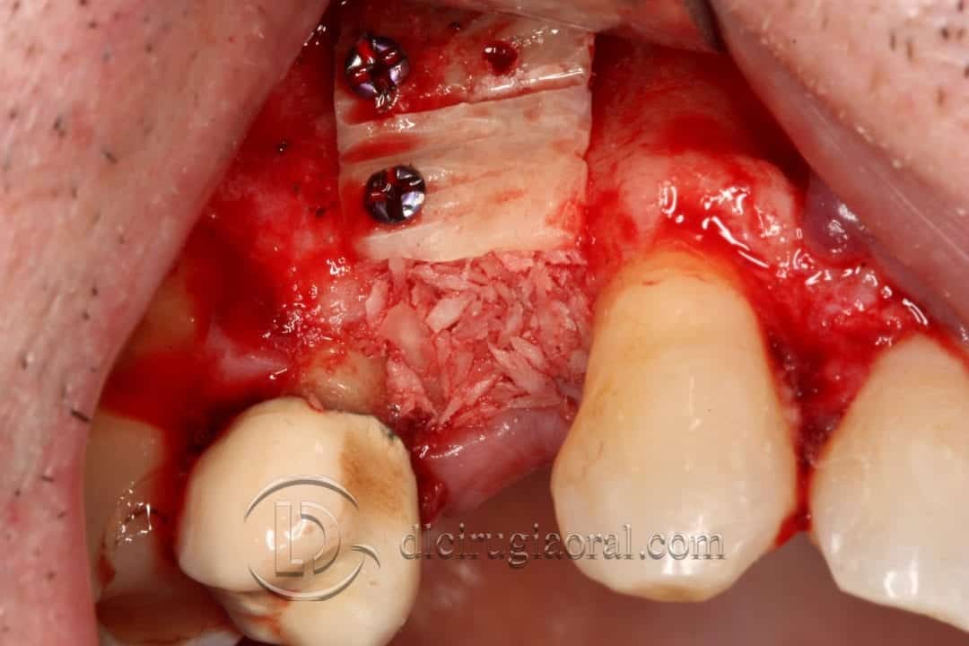 defecto horizontal en premolar superior