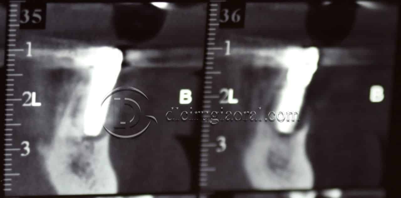 implantes dentales en sobredentadura inferior