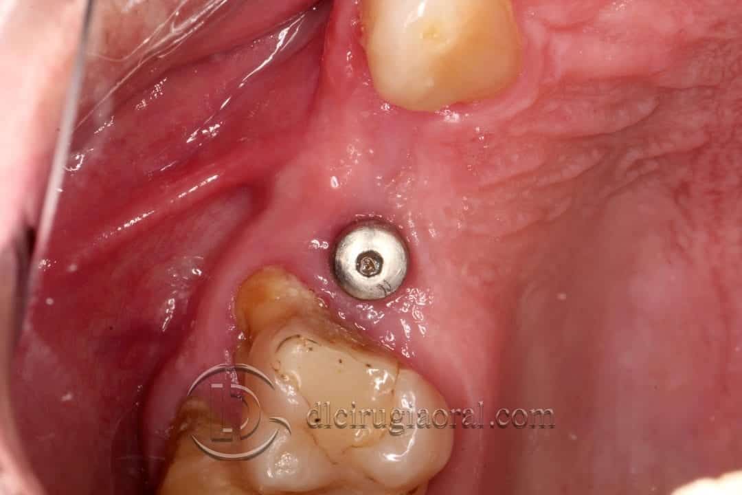 defecto horizontal en premolar superior