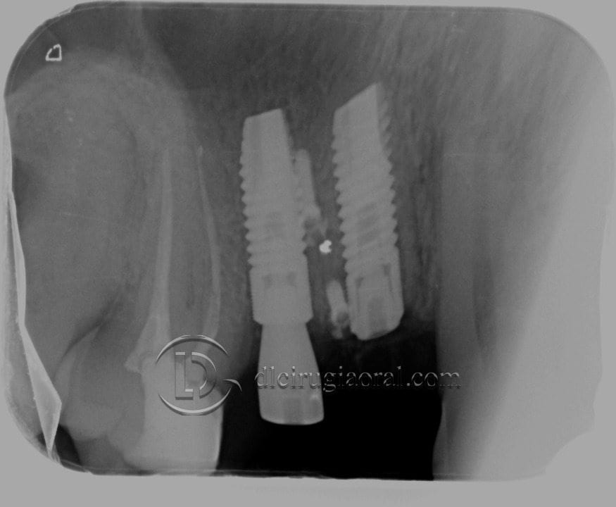 defecto horizontal en premolar superior
