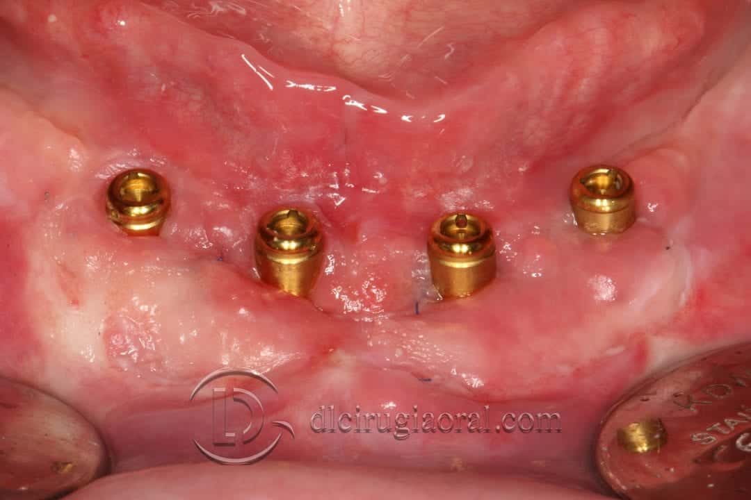 sobredentadura inferior