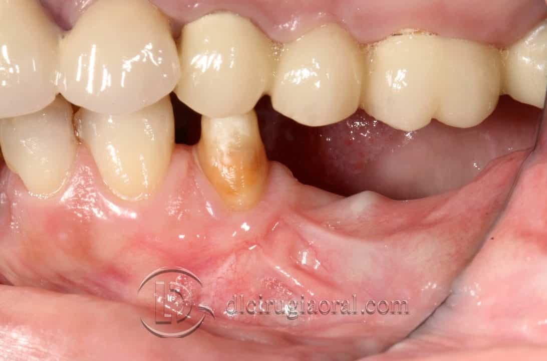 Implantes sobre reconstrucción mandibular 3D