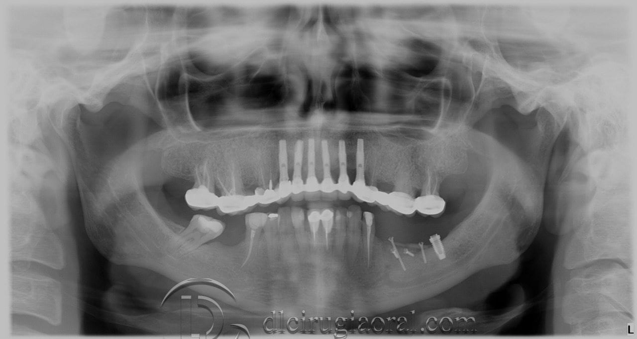 implantes sobre reconstrucción mandibular