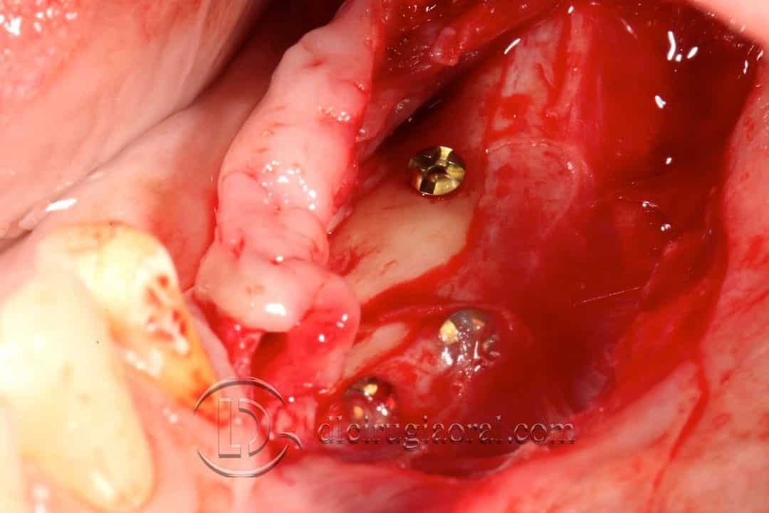 implantes sobre reconstrucción mandibular