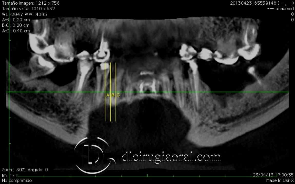 implantes sobre reconstrucción mandibular