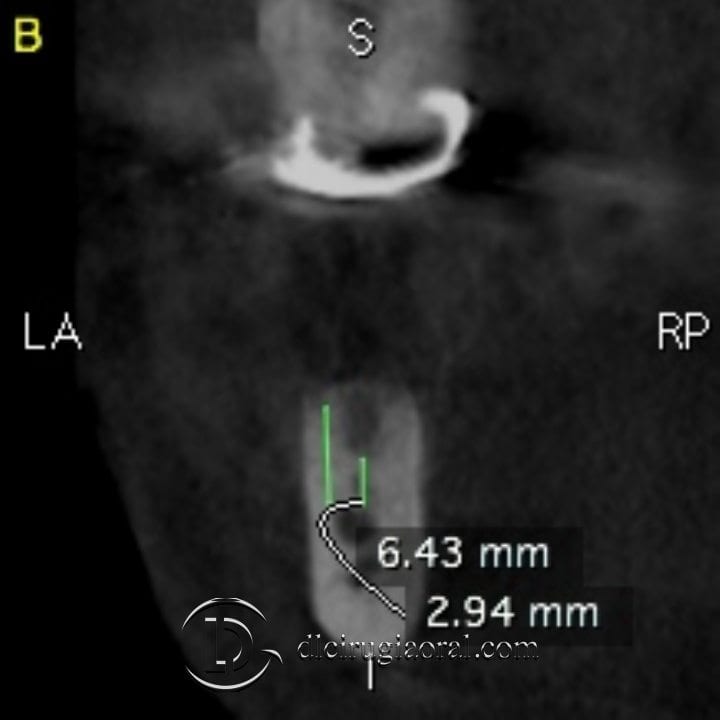 implantes sobre reconstrucción mandibular