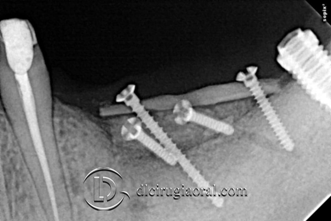 implantes sobre reconstrucción mandibular