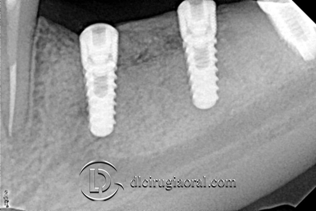 implantes sobre reconstrucción mandibular